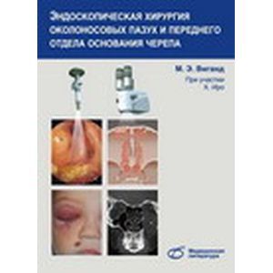 Эндоскопическая хирургия околоносовых пазух и переднего отдела основания черепа